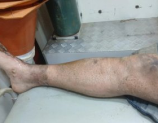 Homem de 39 anos sofre choque el�trico grave ao testar gerador em fazenda